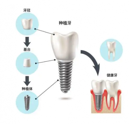 牙種植體基臺系統(tǒng) 春立正達